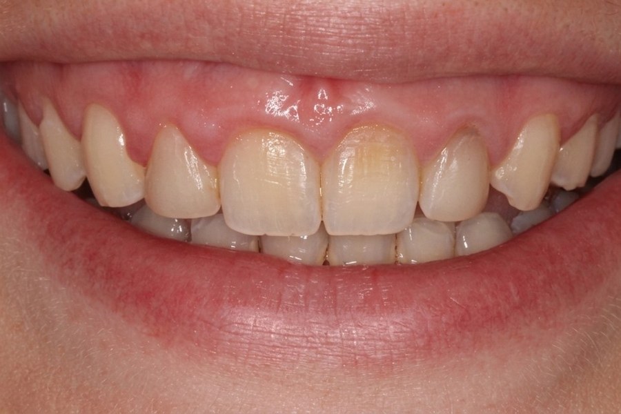 Sorriso antes do tratamento