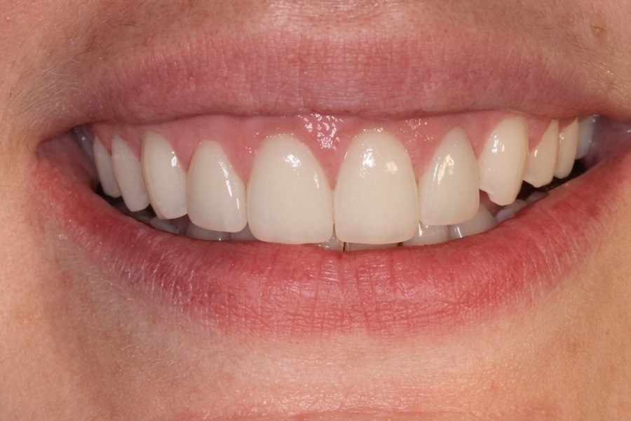 Sorriso depois do tratamento