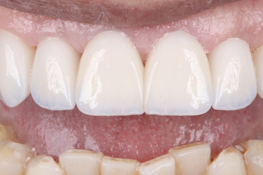 Sorriso depois do tratamento