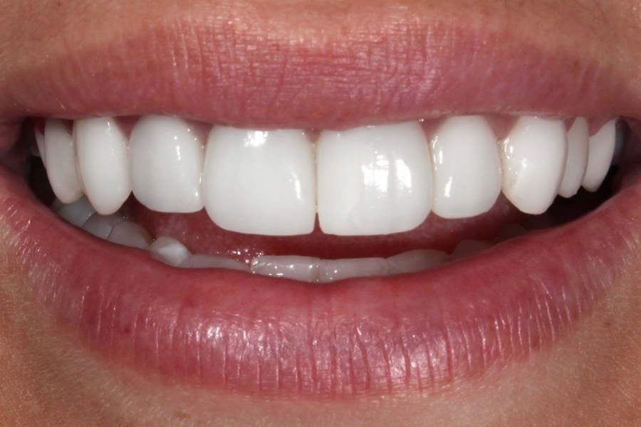 Sorriso depois do tratamento